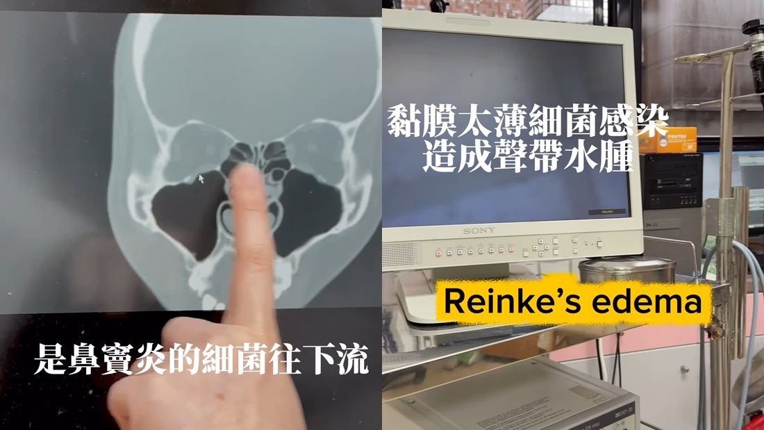 ▲▼Albee失聲。（圖／翻攝自Instagram／albeefin）