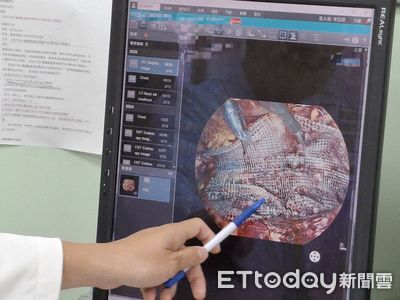 男童右鼠蹊部冒腫塊 「小兒疝氣」微創手術30分鐘就解決