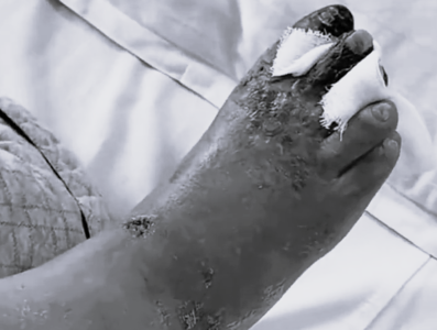 糖尿病男剪趾甲破皮「失去10根腳趾」 醫嘆:相鄰部位迅速潰爛