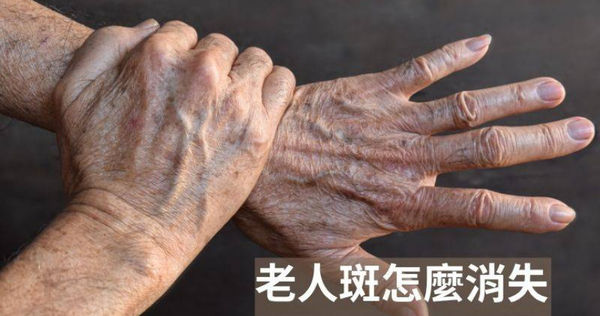 老人斑其實也象徵著身體一些狀況。（圖／翻攝自FB 思思醫師）