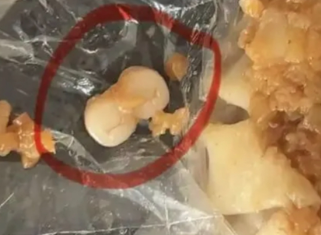 ▲燒賣中疑似2顆牙齒的異物。（圖／翻攝自微博）