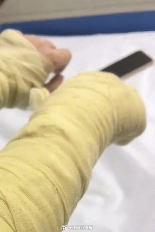 ▲▼正妹直播主打開包裹竟爆炸　毀容送醫「雙眼腫剩一條線」。（圖／翻攝自《江南都市報》）