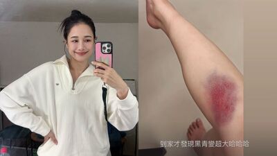 千千PO大片瘀青照! 「深紅紫黑佔半個腿肚」粉絲嚇壞