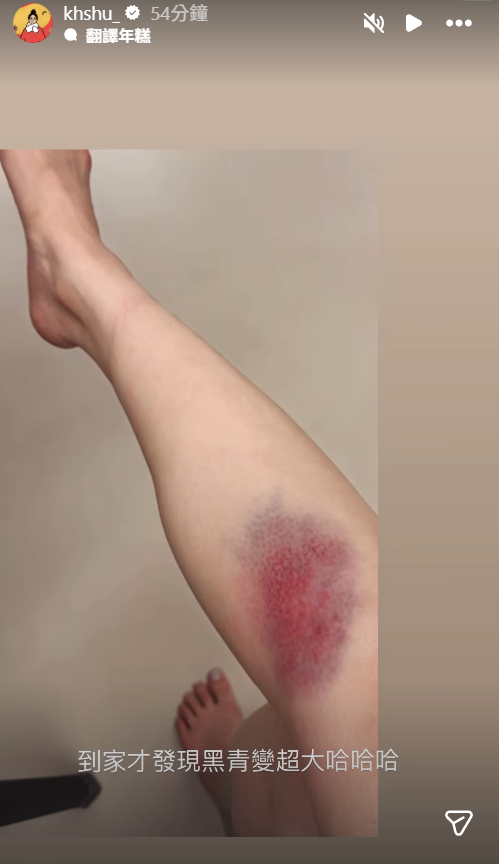 ▲▼千千PO大片瘀青照。（圖／翻攝自Instagram／khshu_）