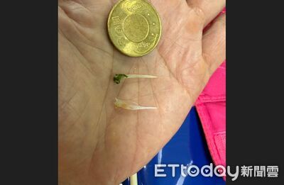 爽吃海鮮大餐喝到斷片！隔天胸痛...竟是2根「兇器」插食道險死