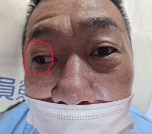 ▲▼一名50多歲男子左側腦幹中風，左眼可正常轉動，但右眼眼球(紅圈處)卻偏向一邊，到員榮醫院接受神經內科陳彥秀醫師治療後已康復。（圖／員榮醫院提供）