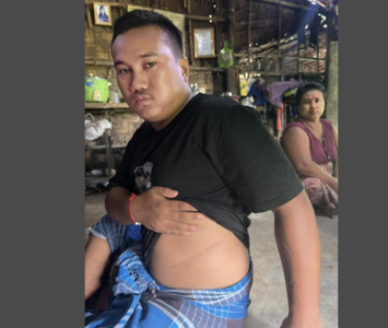 緬甸人窮怕了！組團「赴印度賣腎」1顆賣10萬　全村一半人賣過器官