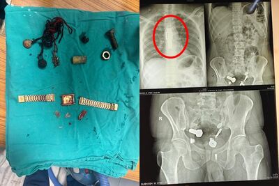 男子腹部劇痛！檢查發現「手錶卡食道」　腸內有鐵片、鏍絲釘