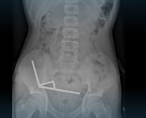 13歲童吞下100顆磁鐵!腸子「吸成四條鏈」壞死 醫急切除保命