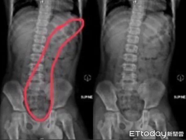 ▲小五男童上廁所不專心，滿肚子都是屎。（圖／記者許宥孺攝）