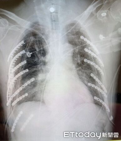 ▲台中醫院胸腔外科團隊成功為患者進行鈦合金肋骨固定手術，三週後康復出院。（圖／記者游瓊華翻攝）