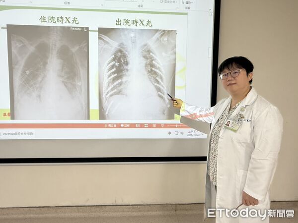 ▲台中醫院胸腔外科團隊成功為患者進行鈦合金肋骨固定手術，三週後康復出院。（圖／記者游瓊華翻攝）