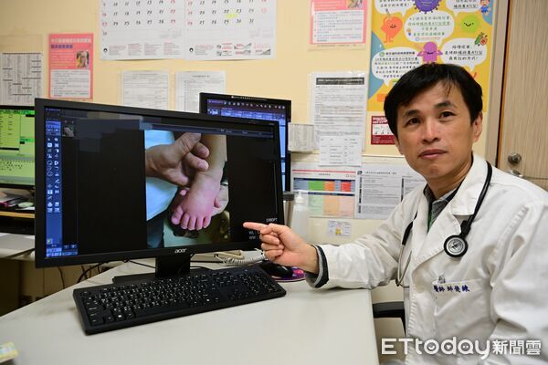 ▲連日高燒、手腳腫脹，經診斷為川崎病，接受免疫球蛋白治療後康復。（圖／記者游瓊華翻攝）