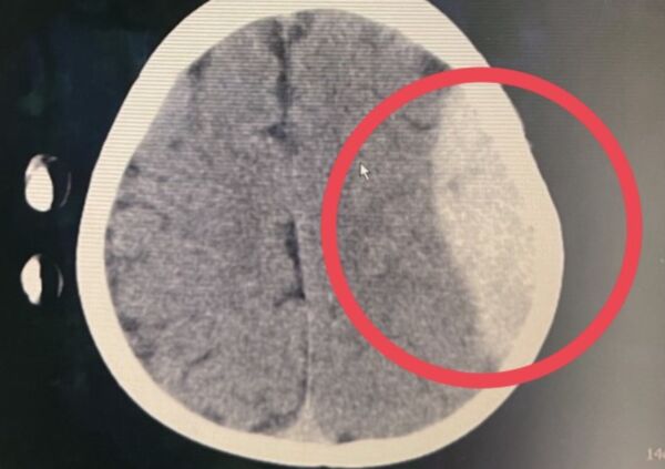 ▲▼左側顱內大面積出血。（圖／耕莘醫院提供）