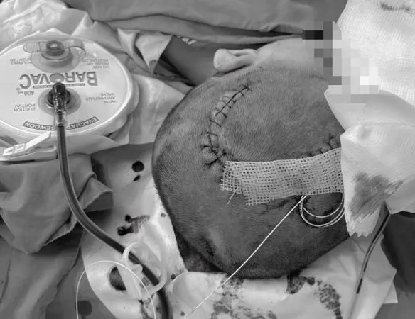 ▲▼左側顱內大面積出血。（圖／耕莘醫院提供）