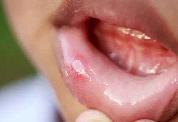 ▲李先生反覆嘴破20年。（示意圖／翻攝自微博）