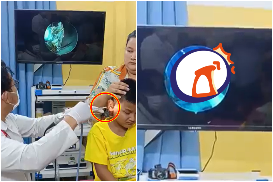 男童耳朵痛! 竟夾出「整隻活蟑螂」還在動 恐怖過程曝