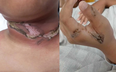 金屬項鍊纏平板充電線起火　男童睡夢中「脖子嚴重燒傷」送醫