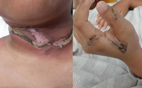 金屬項鍊纏充電線突然起火　男童睡夢中「脖子嚴重燒傷」送醫。（圖／翻攝自Facebook）