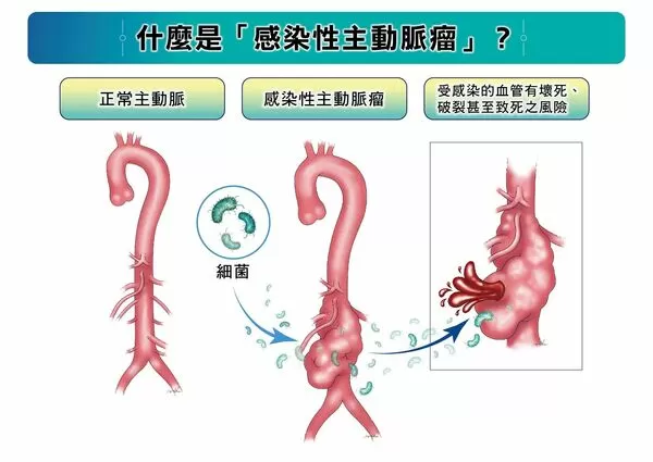 ▲▼感染性主動脈瘤是由病原體(如細菌)入侵主動脈，導致血管壁壞死、破裂的罕見疾病，若未即時治療，死亡風險極高。（圖／長庚醫院提供）