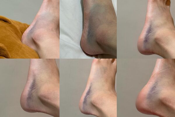 ▲南珉貞跳舞重摔「腳整片發紫」。（圖／翻攝自南珉貞Threads）