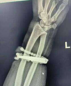 33歲女「手鐲戴10年」沒摘過　變胖「長進肉裡」手腕爛掉