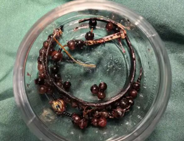 ▲▼33歲女「手鐲戴10年」沒拿下過　「長進肉裡」手腕爛掉流膿汁。（圖／翻攝極目新聞）