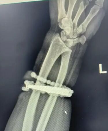 ▲▼33歲女「手鐲戴10年」沒拿下過　「長進肉裡」手腕爛掉流膿汁。（圖／翻攝極目新聞）