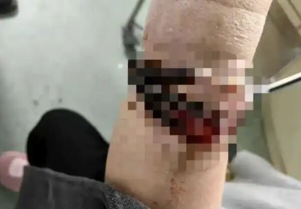 ▲▼33歲女「手鐲戴10年」沒拿下過　「長進肉裡」手腕爛掉流膿汁。（圖／翻攝極目新聞）