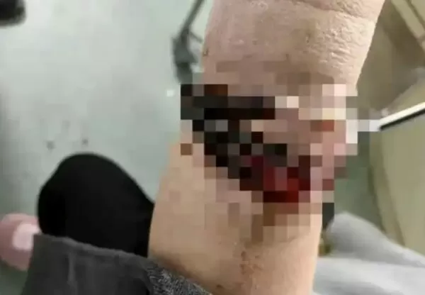 ▲▼33歲女「手鐲戴10年」沒拿下過　「長進肉裡」手腕爛掉流膿汁。（圖／翻攝極目新聞）