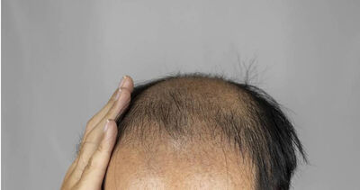 愛喝2飲品小心變禿頭 專家勸每日少喝一瓶:多留一撮頭髮