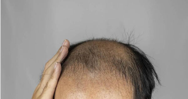 禿頭。（示意圖／photoAC）