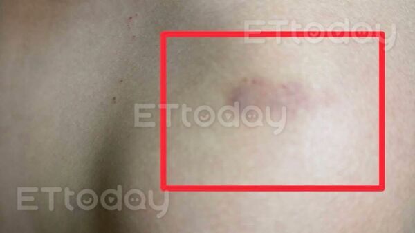 ▲老師把國二生的肩膀掐出黑青，家長帶去驗傷            。（圖／記者吳奕靖翻攝）