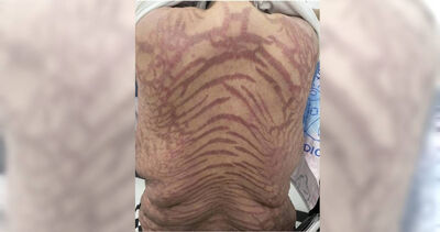 狂擦「萬能神藥」!40歲女全身冒紫紅斑紋 醫曝危險成分