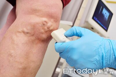 女「雙腿靜脈曲張」癢到抓破皮 靠「靜脈膠水治療」1個月痊癒