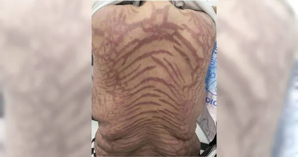 大陸南京一名40歲女子美美（化名）長年塗抹網購藥物，結果確診「繼發性腎上腺皮質功能減退」，醫師也指出藥膏成分是強效激素，對身體有害。（圖／翻攝自微博／揚子晚報）