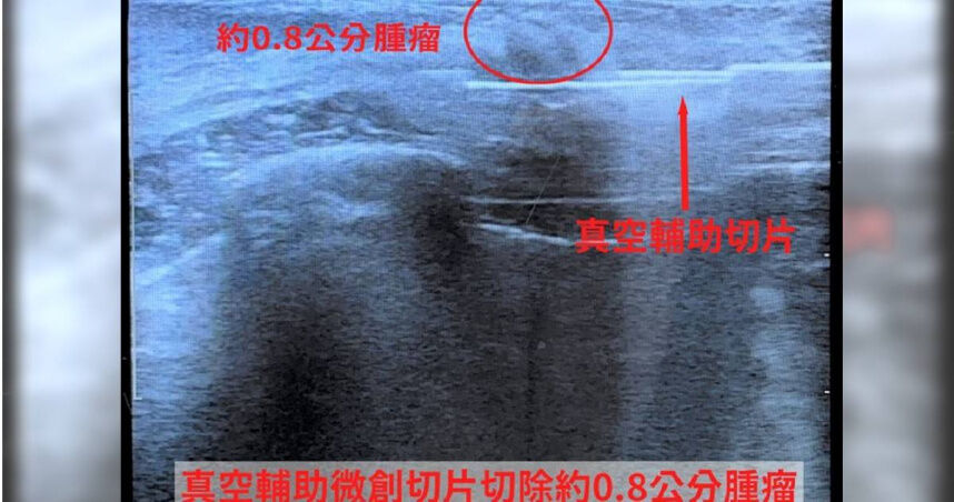 24歲女胸部突爆痛!就醫驚見0.8公分腫瘤 醫揭致病1關鍵