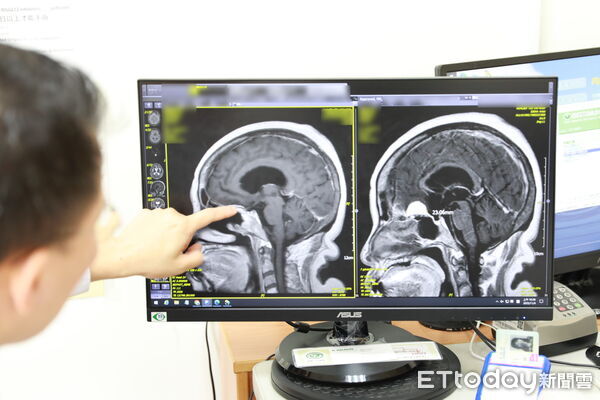 ▲▼跨科團隊合作的雙手聯彈經鼻經蝶竇腦瘤清除術，由內視鏡經驗豐富周昱甫醫師（中）先行開道打開顱底，整理出空間。右為在旁準備的神經外科主任蔡昇宗醫師。（圖／慈濟醫學中心提供，下同）