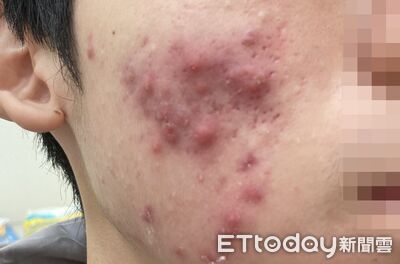 學測壓力大!高三生熬夜嗑炸物+手搖飲 慘變「爛臉哥」不敢見人