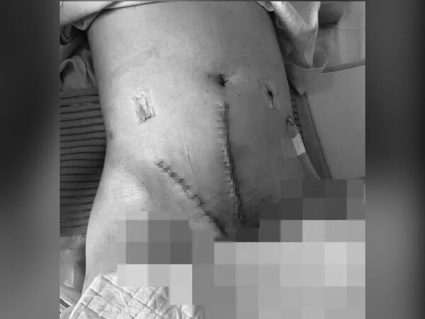 ▲女子接受子宮肌瘤手術，術後腹腔爆血命懸一線，至今肚子上仍留存2道明顯疤痕。（圖／翻攝自爆料公社）