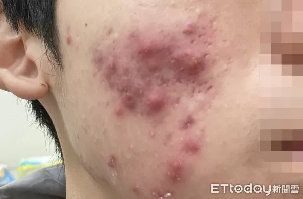 ▲青春痘,痤瘡。（圖／亞大附醫提供）