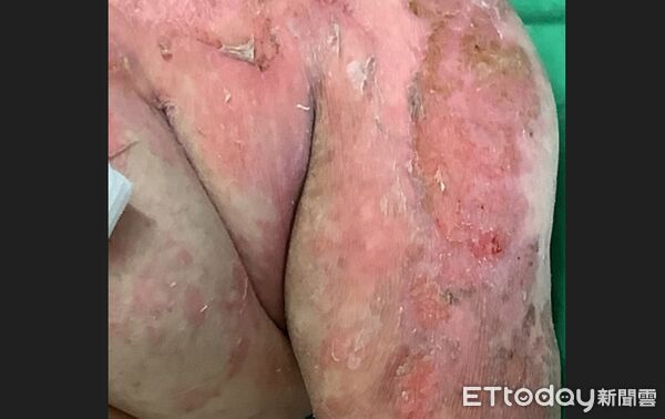 ▲恐怖藥物過敏！她全身長水泡險死　就醫才知免疫系統「整組壞了」。（圖／台中榮總提供）