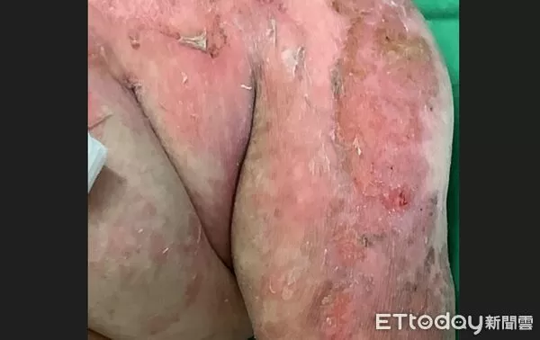 ▲恐怖藥物過敏！她全身長水泡險死　就醫才知免疫系統「整組壞了」。（圖／台中榮總提供）