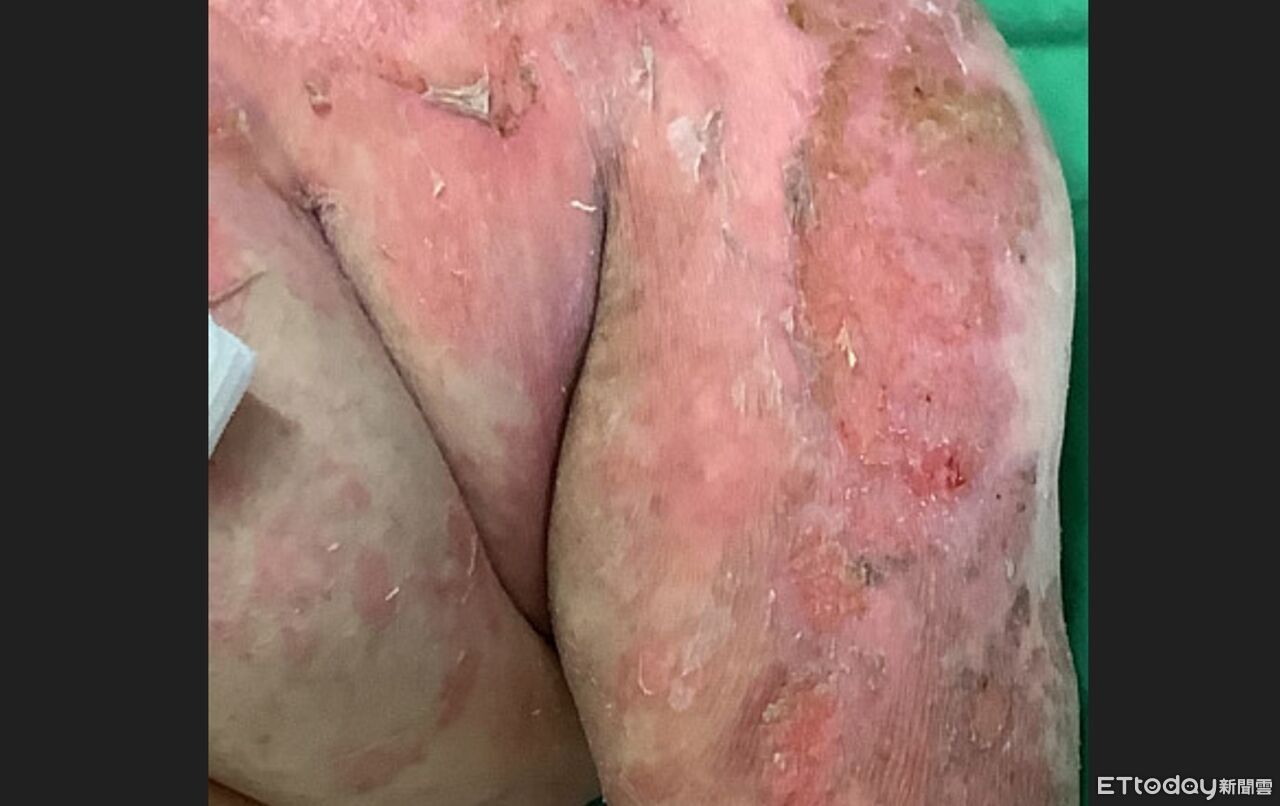 恐怖藥物過敏她全身長水泡險死　就醫才知免疫系統「整組壞了」