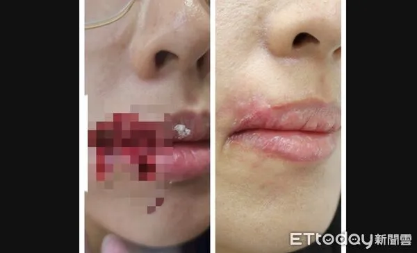 ▲與柴犬玩下一秒濺血！28歲台中女臉頰遭咬穿撕裂4cm送醫急救 。（圖／記者游瓊華翻攝）