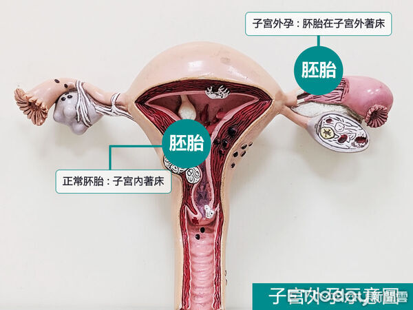 ▲安泰醫院高危險妊娠團隊救回高婦生命。（圖／安泰醫院提供）