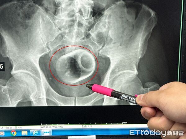 ▲▼台中男子3天無法解便，竟是肛門塞了瓷杯。（圖／李綜合醫院提供，下同）