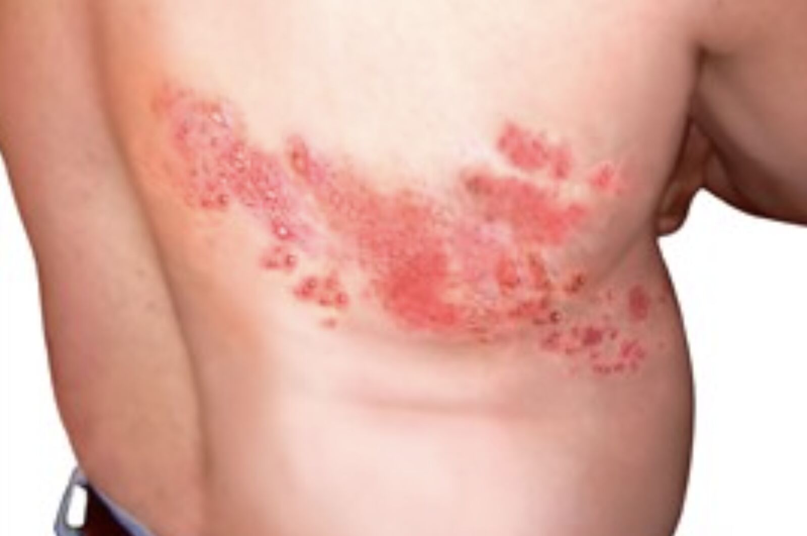 帶狀皰疹。（圖／北市聯醫提供）