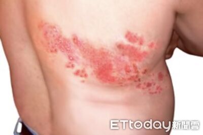 帶狀皰疹復發率高　醫示警「6大高風險群」睡不好、壓力大都中招