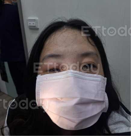 ▲右上眼瞼被螫成眼眶前蜂窩性組織炎。（圖／洪啟庭醫師提供）